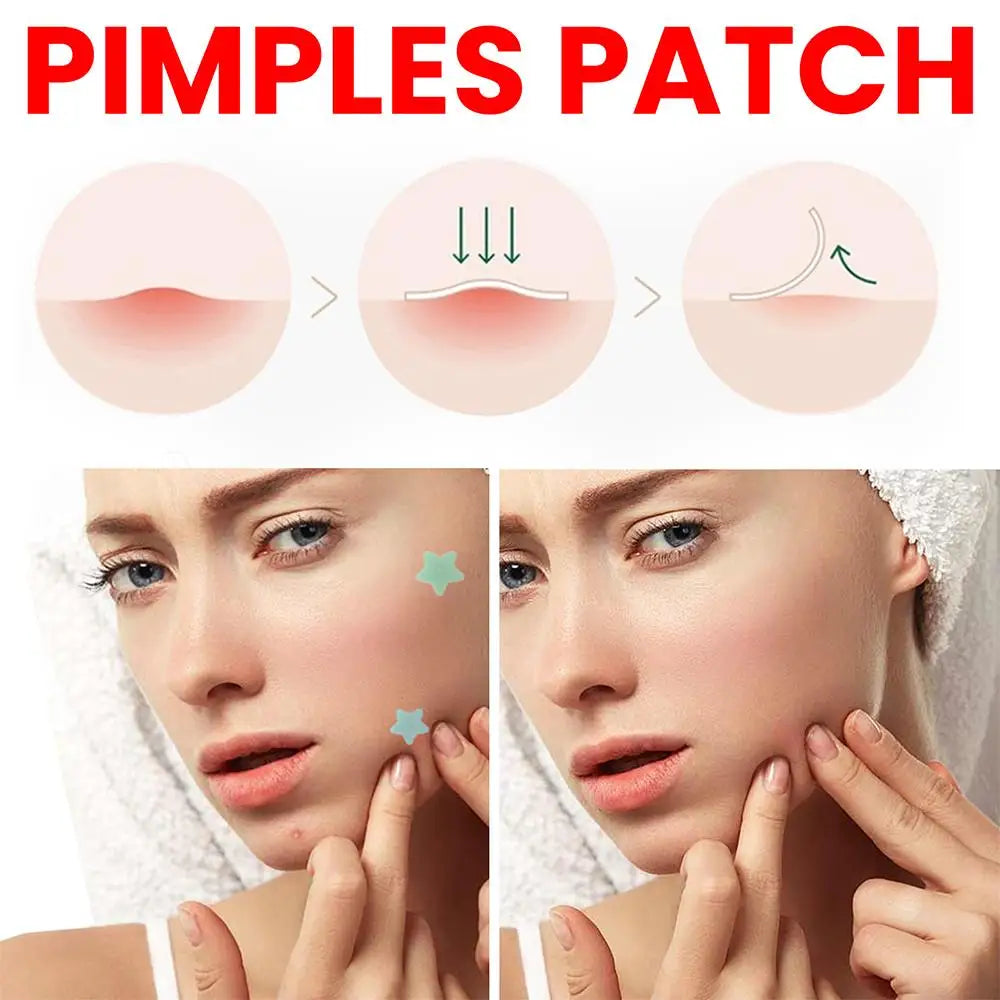 200pcs Star Pimple Patch Acne Colorful Invisible Acne